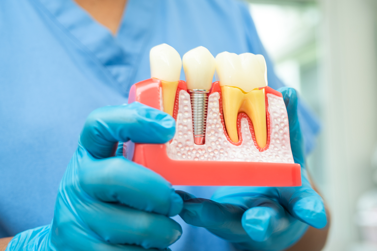 prothèses dentaires